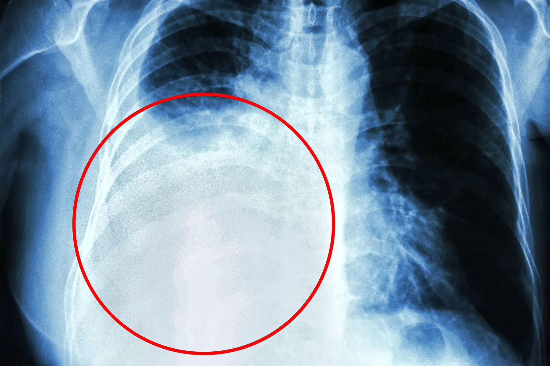 Pleural effusion treatment in Jaipur