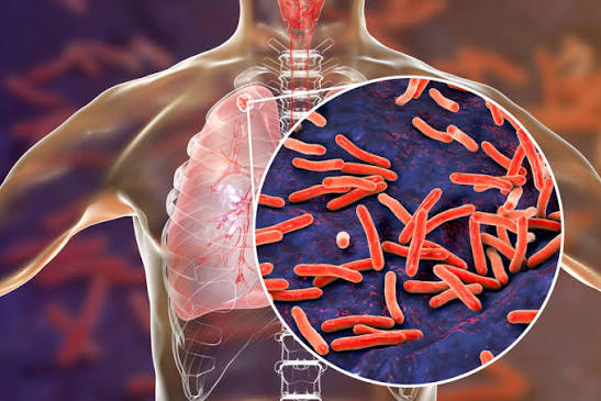 Tuberculosis treatment in Jaipur